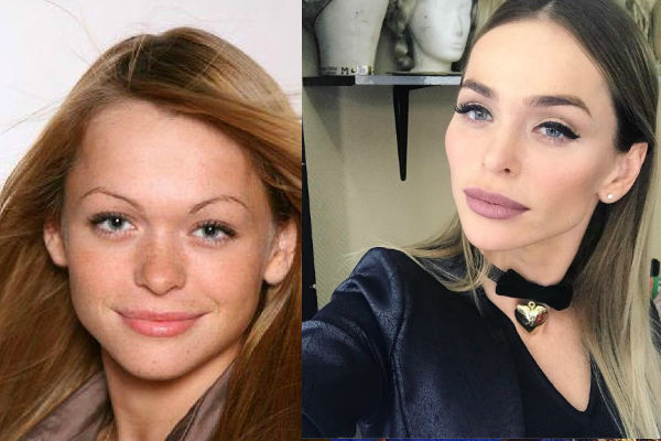 Анна Хилькевич до и после пластики — фото